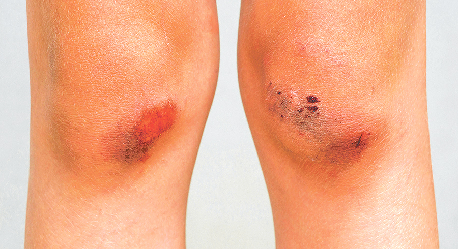 Auch seelische Wunden brauchen Zeit zum Heilen. Je tiefer die Kränkung, desto mehr Fürsorge sollte man sich selbst angedeihen lassen. / spyrakot/Adobe Stock Auch seelische Wunden brauchen Zeit zum Heilen. Je tiefer die Kränkung, desto mehr Fürsorge sollte man sich selbst angedeihen lassen.