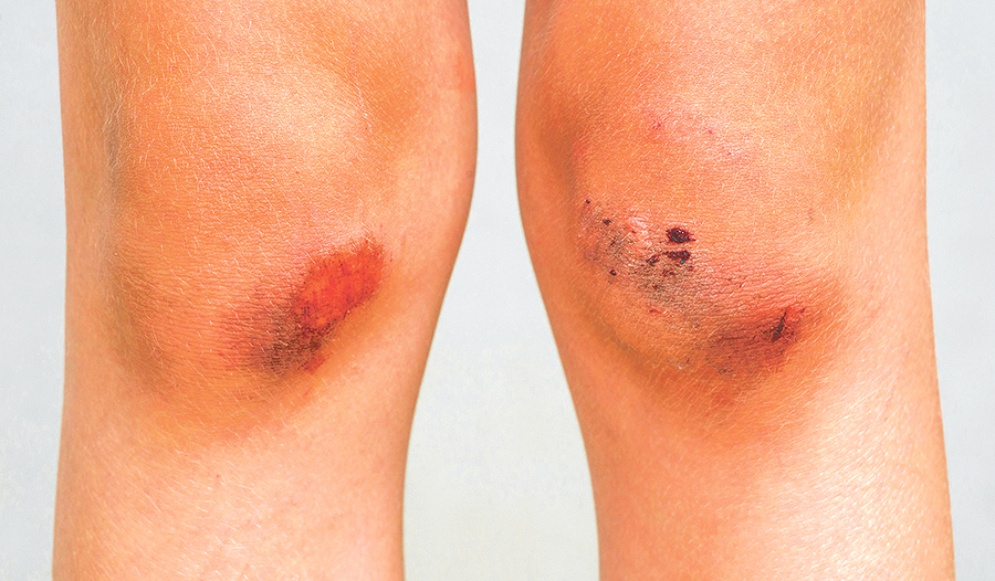 Auch seelische Wunden brauchen Zeit zum Heilen. Je tiefer die Kränkung, desto mehr Fürsorge sollte man sich selbst angedeihen lassen.